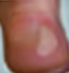 The Fastest Way to Get Rid of Blisters