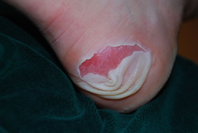 How to get rid of blisters